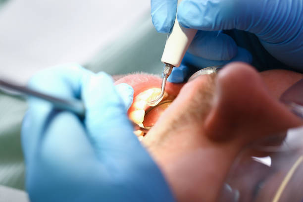 Best Emergency Tooth Extraction in South Park, WY
