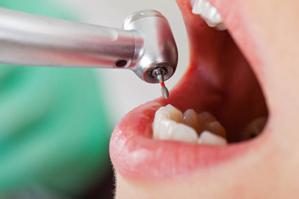 Best Emergency Tooth Extraction in South Park, WY